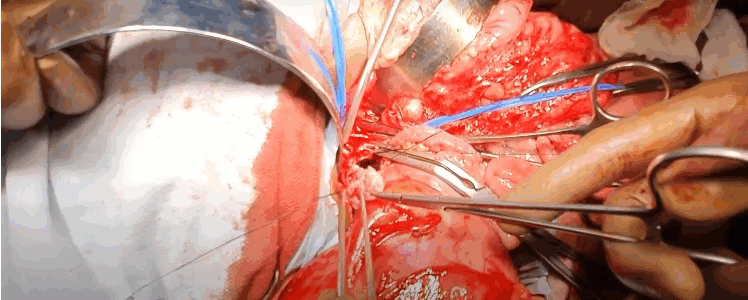 Wilms' Tumor with IVC Thrombus delivery