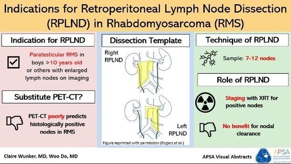LN dissection in Rhabdomysosarcoma
