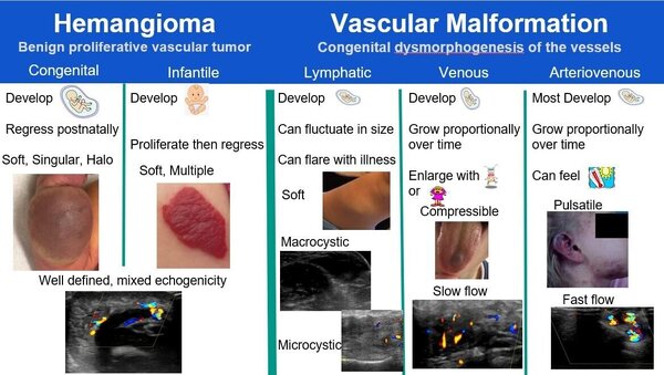 Hemangioma vs Vascular malformation