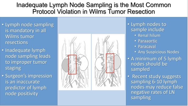 LN sampling in wilms tumor