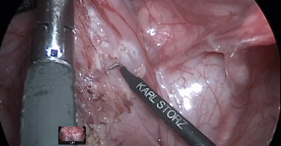 Laparoscopic Assisted swenson pull through Procedure for Hirschsprung Disease