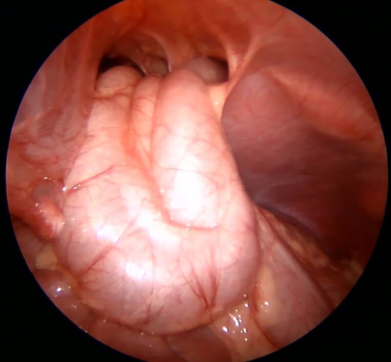 Laparoscopic repair of a congenital Morgagni-Larrey bilateral diaphragmatic hernia