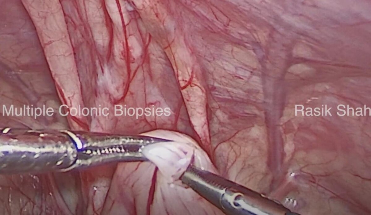 Laparoscopic multiple colonic biopsy or mapping in Hirschsprung's disease