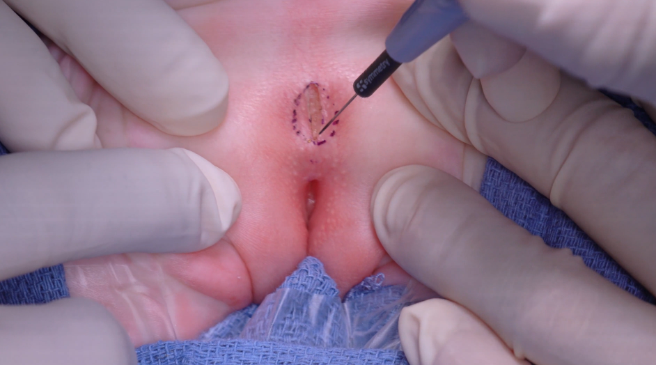 Sparing the perineal body – a modification of psarp for rectovestibular fistulae