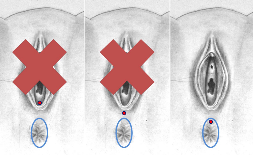 Posterior rectal advancement anoplasty