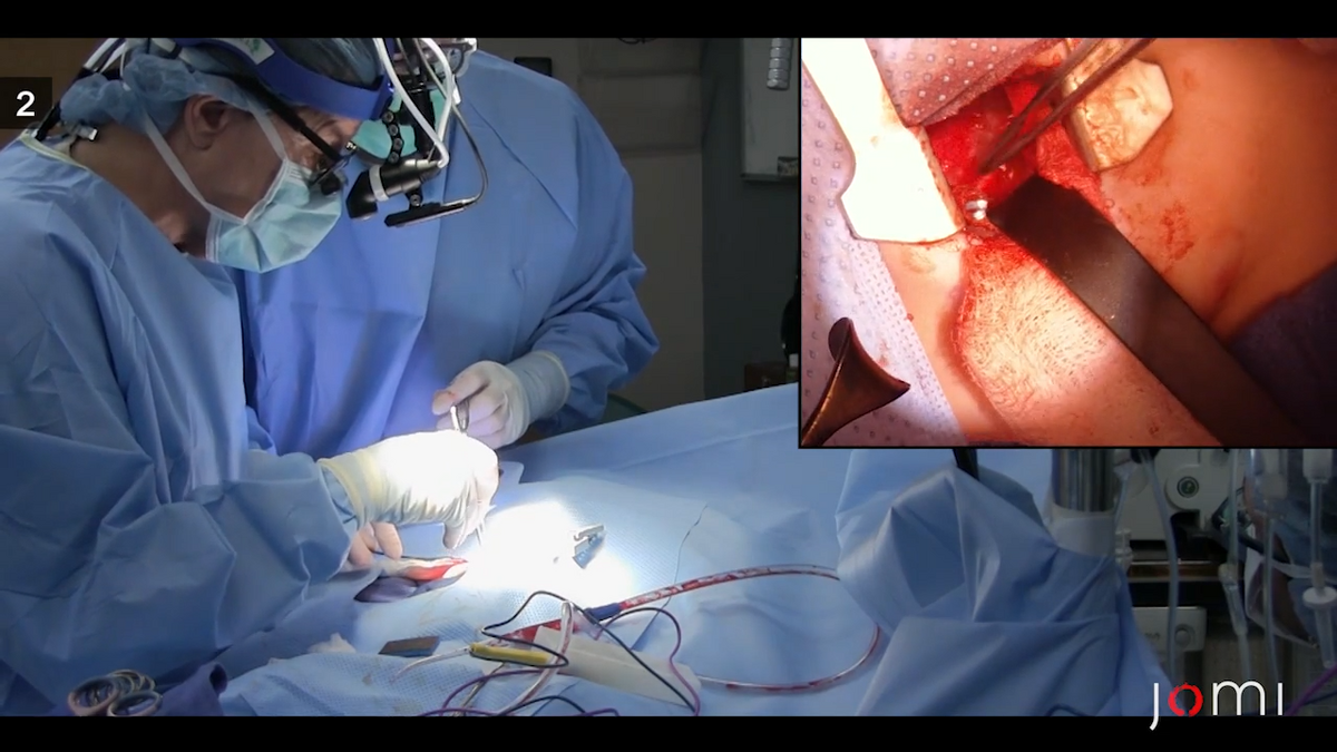 Aortopexy for Innominate Artery Compression of the Trachea