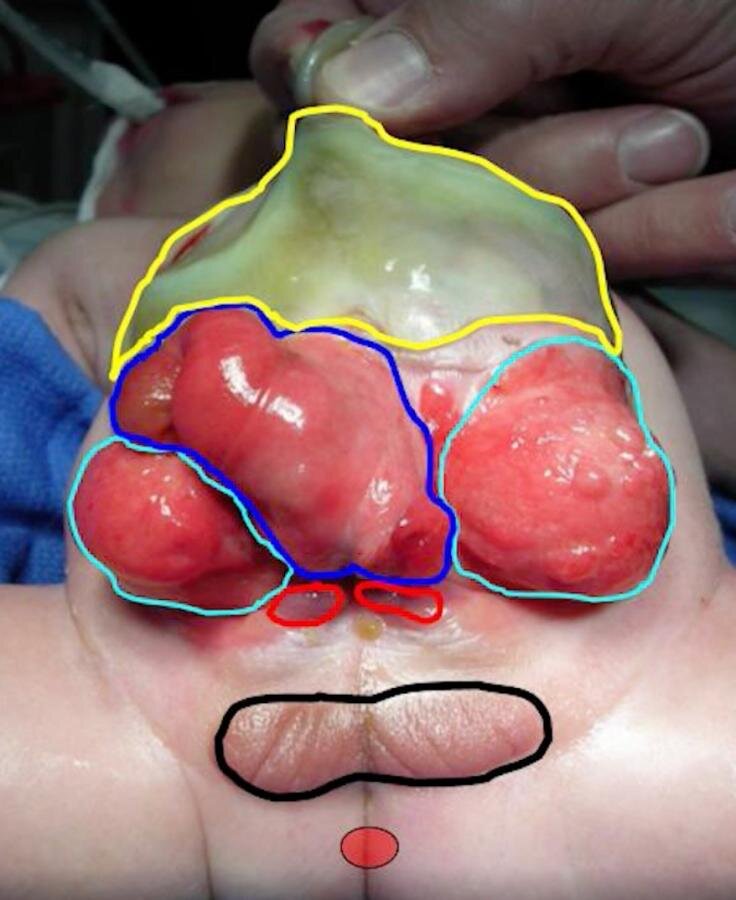 Cloacal Exstrophy: Leaving the Cecal Plate Untouched