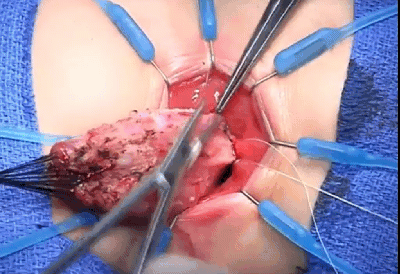 Transanal swenson for Hirschsprung disease