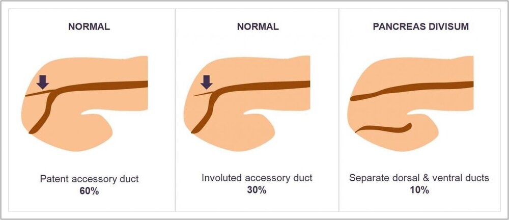 Pancreas Divisum - PD - Home.jpg