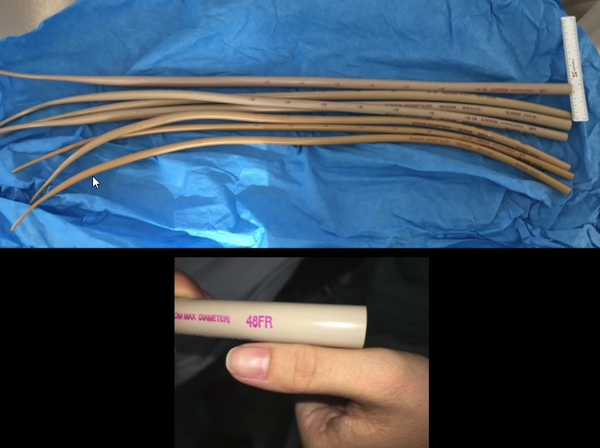 role of patient thumb to determine size of required esophageal bougie