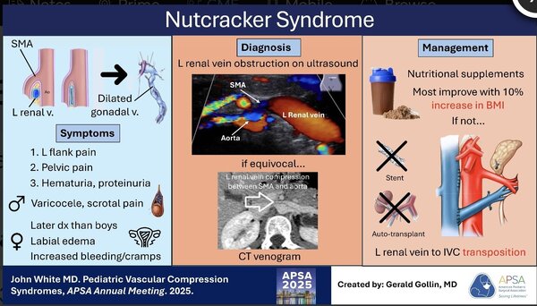 Nutcracker syndrome