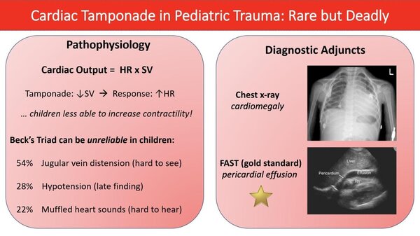 Cardiac tamponade