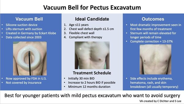 Vacuum bell for pectus excavatum