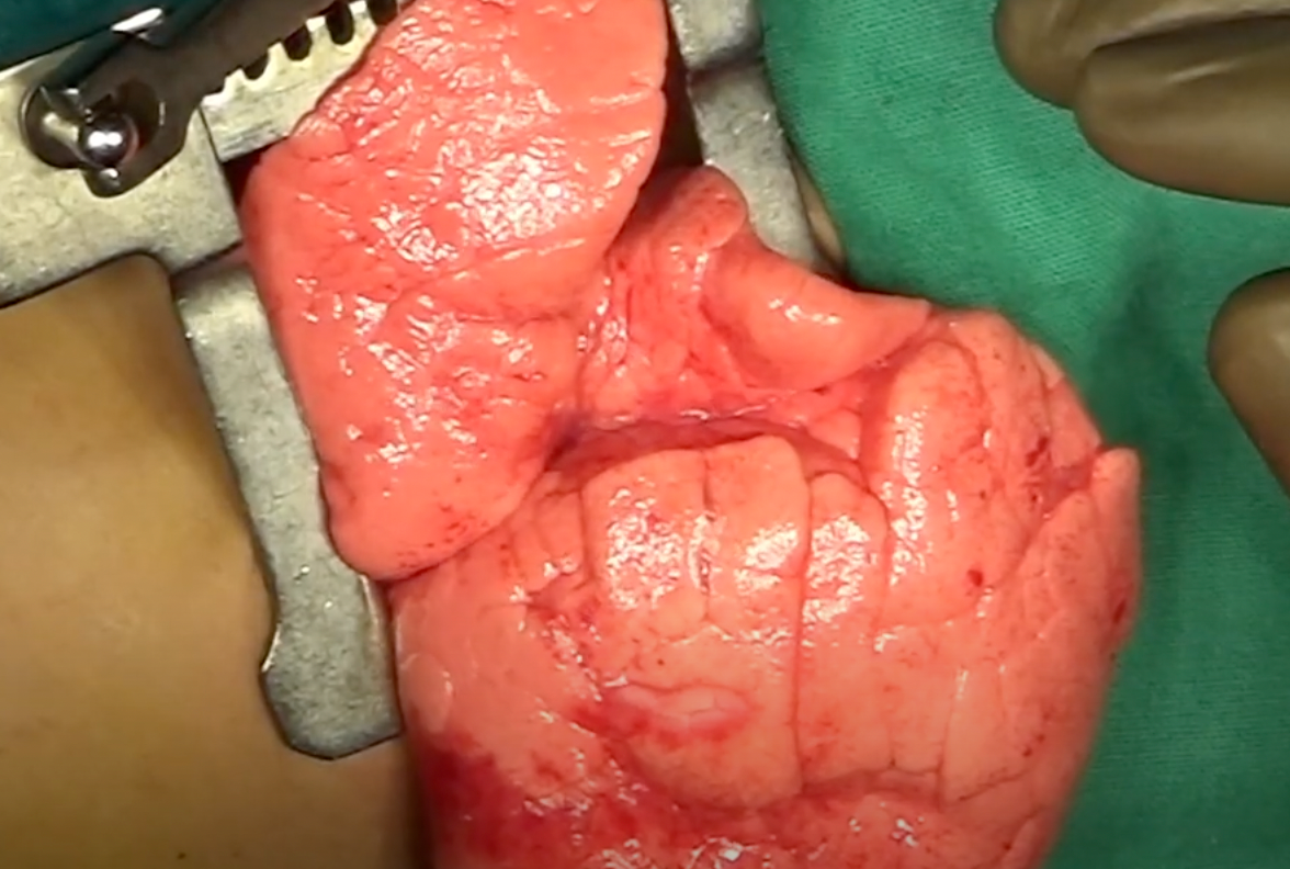 LEFT LUNG UPPER LOBECTOMY FOR CONGENITAL LOBAR EMPHYSEMA