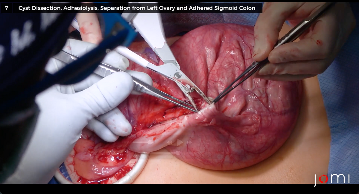 Pediatric Exploratory Laparotomy and Left Ovarian Cystectomy