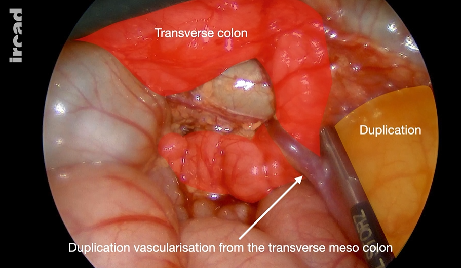 Volvulus of colonic duplication cyst in a 5-week-old baby: laparoscopic approach