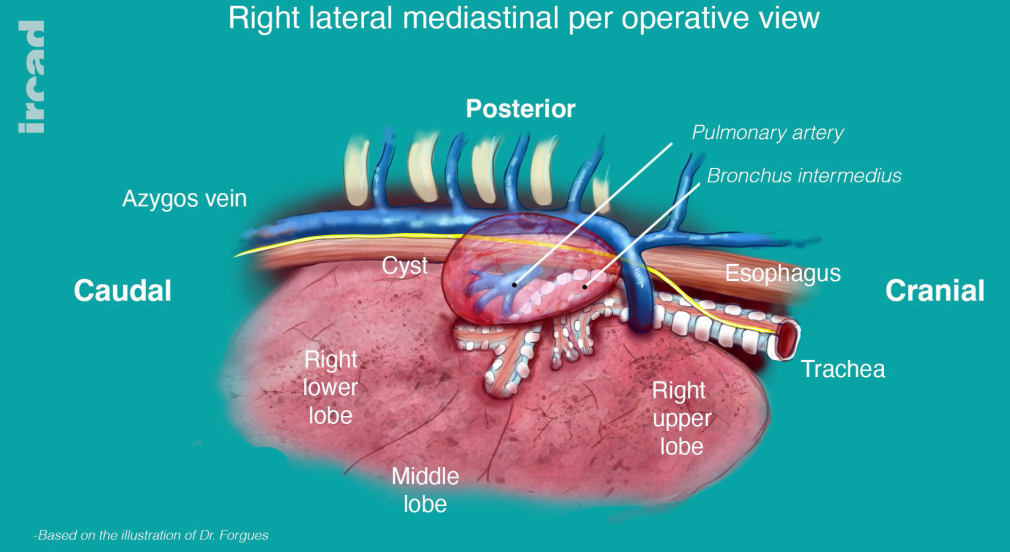 Video-assisted thoracoscopy for the management of right mediastinal bronchogenic cyst: about 2 cases in toddlers