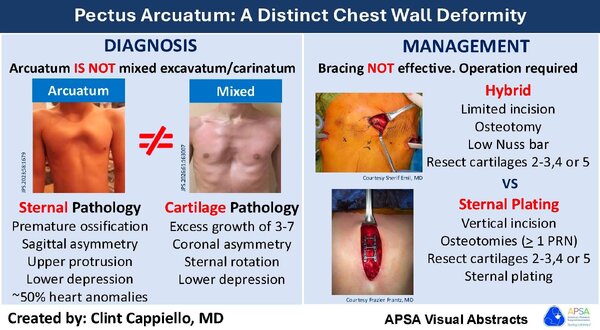pectus arcuatum